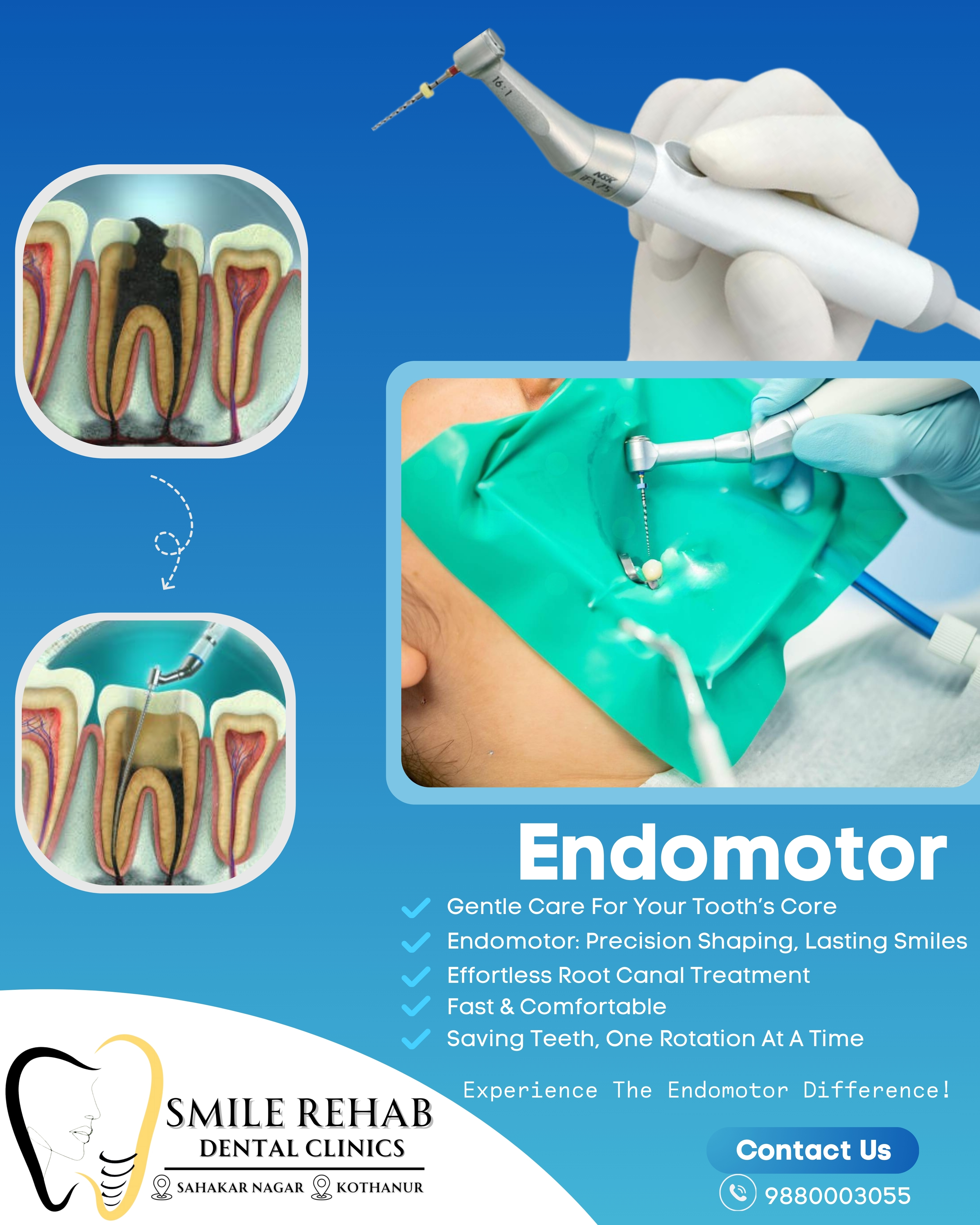EFFORTLESS ROOT CANAL TREATMENT