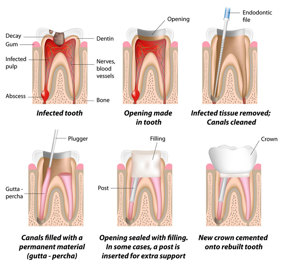 ROOTCANAL