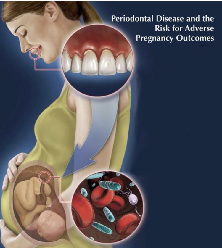 DENTAL CARE DURING PREGNANCY