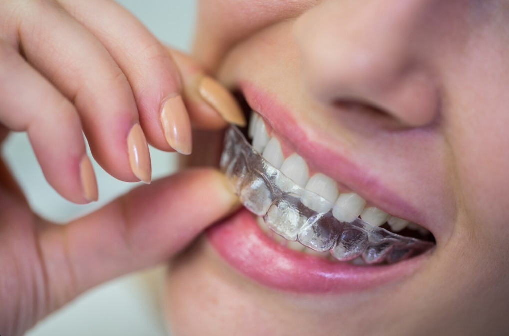 INVISALIGN PROVIDER NEAR ME